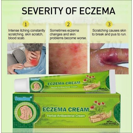 ECZEMA CREAM ANTI ITCHING CREAM ANTI BACTERIAL HERBAL CREAM
