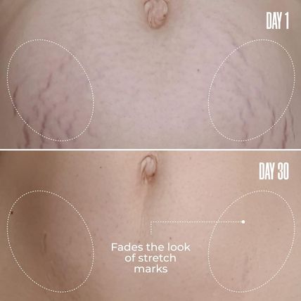 MAËLYS Cosmetics B-FLAT Belly Firming Cream - Stretch Mark, Tightening Belly Cre