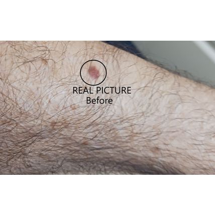 TAG OFF!!! Natural Skin Tag Remover, This Stuff Works! Is Real Excellent Product