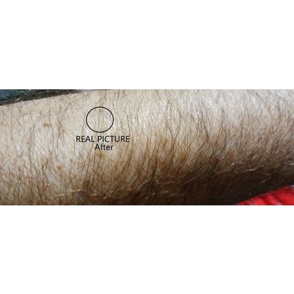 TAG OFF!!! Natural Skin Tag Remover, This Stuff Works! Is Real Excellent Product