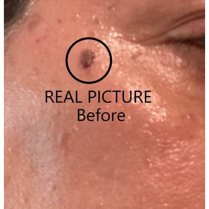 TAG OFF!!! Natural Skin Tag Remover, This Stuff Works! Is Real Excellent Product