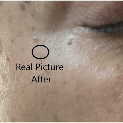 TAG OFF!!! Natural Skin Tag Remover, This Stuff Works! Is Real Excellent Product