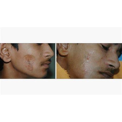 3 PACK Contractubex gel x20 g Merz- cosmetic scars after surgeries