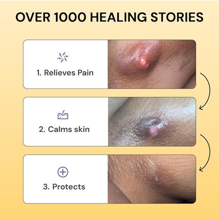 Universal Flare Care | Relief for 97% of Skin Issues | Cysts, Inflamed Skin, Hid
