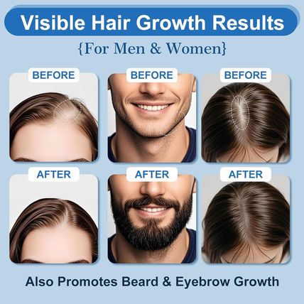 5% Minoxidil Foam for Hair & Beard Growth – Thickening Treatment for Men & Women