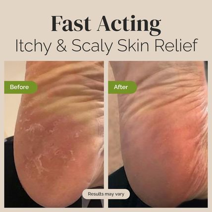 Tea Tree Oil Balm, Extra Strength, Pair Well with Jock Itch Cream, Spray, Athlet