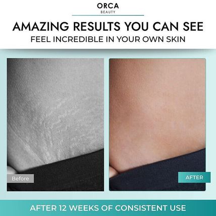 Orca Beauty Belly Butter-Moisturizing Cream for Pregnancy+Stretch Marks-4 fl. oz