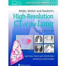 Webb, Muller and Naidich's High-Resolution CT of the Lung