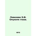 Levkoeva E.F. Swelling of the eye. In Russian /...