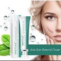 Tratamiento Para El Acne Crema Para Eliminar Es...